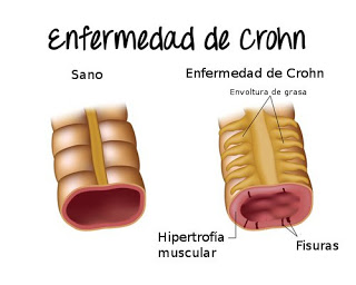 ALIMENTOS PARA LA ENFERMEDAD DE CROHN QUE PUEDEN VENIR BIEN
