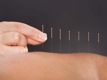 Analgesia de mastocitos y acupuntura