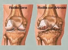 ARTROSIS: REMEDIOS NATURALES CONTRA EL DOLOR, LA INFLAMACION...Y SIN EFECTOS SECUNDARIOS