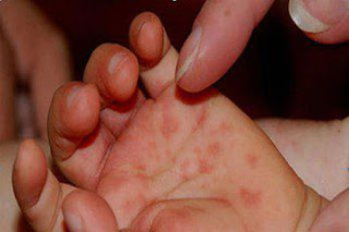 BEBES Y NIÑOS. ENFERMEDAD DE MANOS, PIES Y BOCA