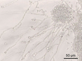  CANDIDIASIS