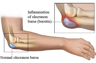COMO TRATAR LA BURSITIS