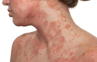 DERMATITIS ATOPICA