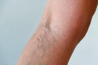 Dolor de piernas y varices!