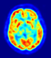 DURANTE TODA LA VIDA MAS DE UN TERCIO DE LAS NEURONAS SE RENUEVAN PERIODICAMENTE
