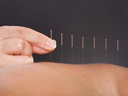El papel de la acupuntura para el dolor miofascial 