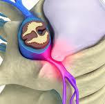 ESTUDIO DE LA EFICACIA DE LA MANIPULACION OSTEOPATICA EN EL TRATAMIENTO DE LA HERNIA DISCAL LUMBAR
