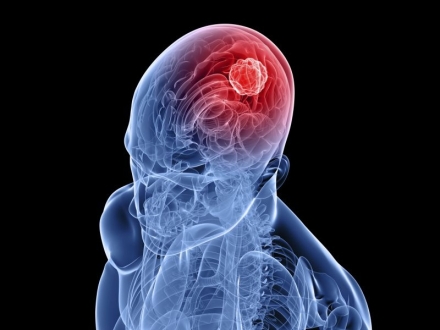 Fitoterapia para el tratamiento del glioblastoma