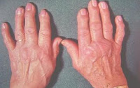 GEL DE ARNICA PARA EL TRATAMIENTO DE LA OSTEARTRITIS DE LAS MANOS