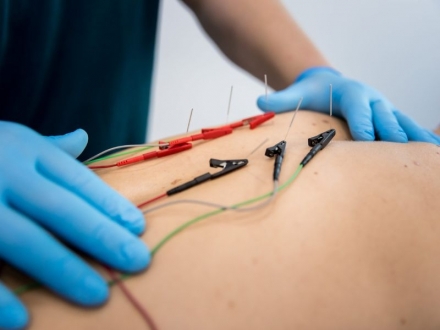 Investigación sobre los efectos de la electroacupuntura comparado con el diclofenaco