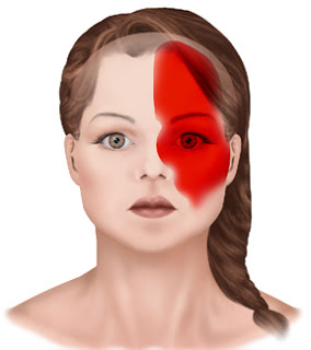 MATRICARIA ENEMIGA DE LA MIGRAÑA