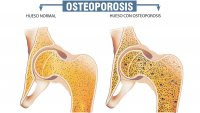 OSTEOPOROSIS, MENOPAUSIA Y MEDICINA NATURAL