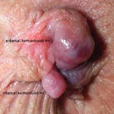 PREVENCION Y TRATAMIENTO NATURAL DE LAS HEMORROIDES