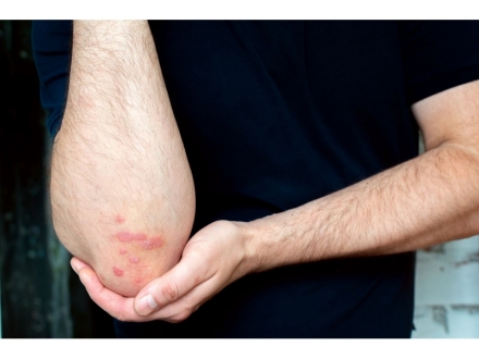 Psoriasis con Acupuntura