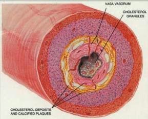 REMEDIOS HERBALES PARA LA ARTERIOESCLEROSIS