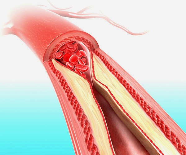 REMEDIOS NATURALES PARA LIMPIAR LAS ARTERIAS