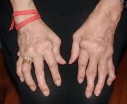TERAPIAS COMPLEMENTARIAS PARA LA ARTRITIS
