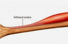 TRATAMIENTO NATURAL DE LA TENDINITIS