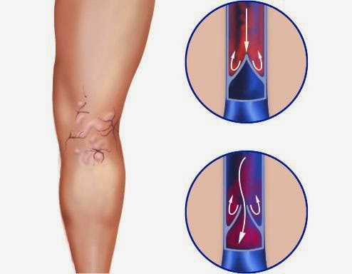 TRATAMIENTOS NATURALES PARA LAS VARICES